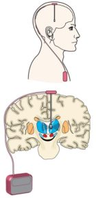 Diagram of implanted deep brain stimulation device